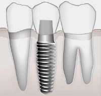 Implantes dentales